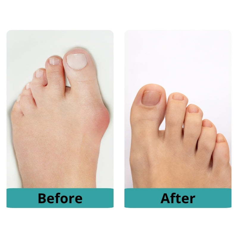 Toe Separator VIP
